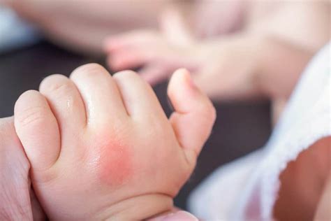 Insect Bites on Babies: See How to Treat Them