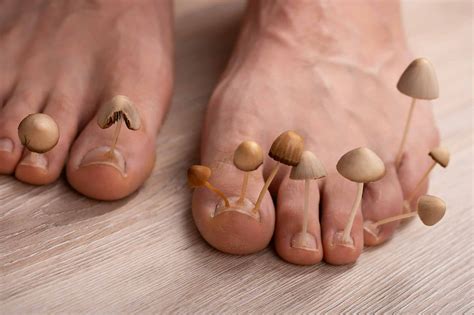 Can You Treat Foot Fungus at Home? (Hint: You Can’t) - Feet First Clinic