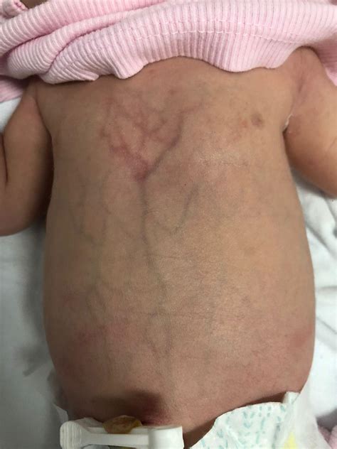 Unusual abdominal collateral vein circulation - nursing the neonate ...