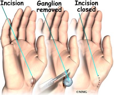 Ganglion Cyst Wrist