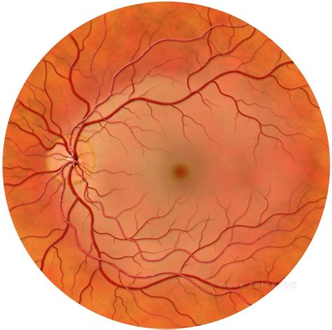 Central retinal artery occlusion (CRAO) illustration