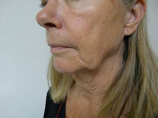 Hair For Saggy Jowls / How To Firm Up And Improve Sagging Face Skin Using Facial Yoga - If you ...