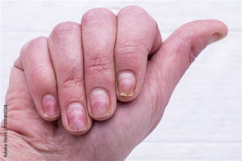 Damage of the nail after using shellac. Onycholysis. Injury of the nail ...