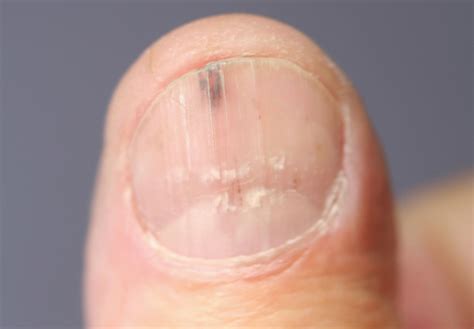 early stage nail cancer pictures | Symptoms and pictures