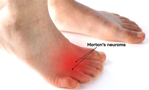 6 Exercises for Morton's Neuroma: Help Alleviate Your Foot Pain – Fits Perfect