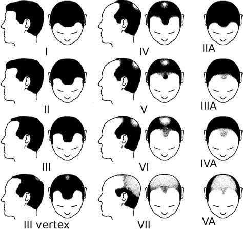 What Is The Norwood Scale & How Bald Are You According To It? - HWM