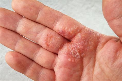 Tratamiento de la dermatitis de contacto - Muy Salud