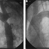 (A) Long axis aortogram using a "marker" pigtail catheter showing... | Download Scientific Diagram