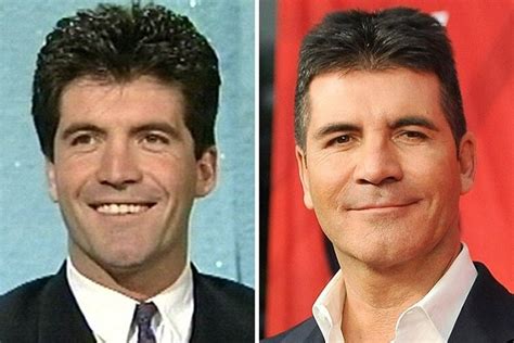 Simon Cowell Before and After Plastic Surgery: Facelift, Botox