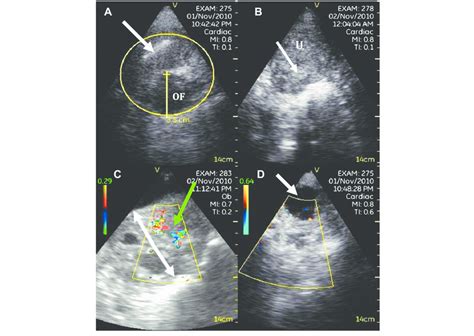 (A) Transvaginal ultrasound linear image of an intrauterine device... | Download Scientific Diagram