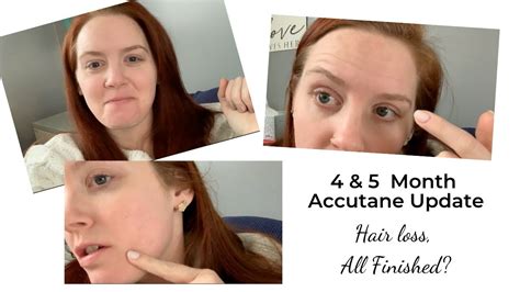 Accutane and Depression Side Effect | Month 4&5 | Hair Loss | Extreme ...