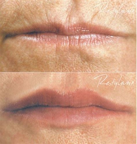 Filler Lips Smokers Lines | Lipstutorial.org