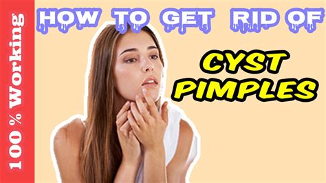 How To Get Rid Of Cyst Pimples Overnight - Fast - Home Remedies - Blackheads - Acne - Remove ...