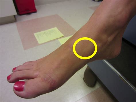 Top of foot hairline fracture - picturedrop