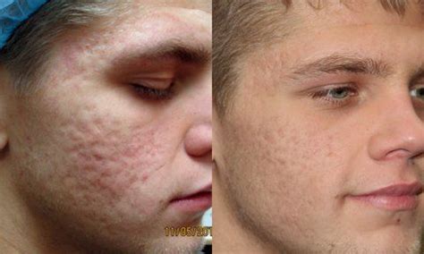 Our Top Tips On Treating Acne Scars - Jeune Ascot Vale