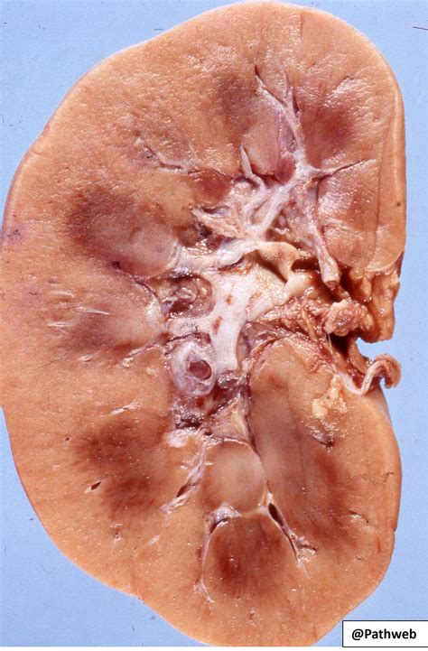 Renal Papillary Necrosis Histology