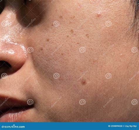 Dark Spots Called Age Spots and on the Face of Asian Man. they are Also Called Liver Spots ...