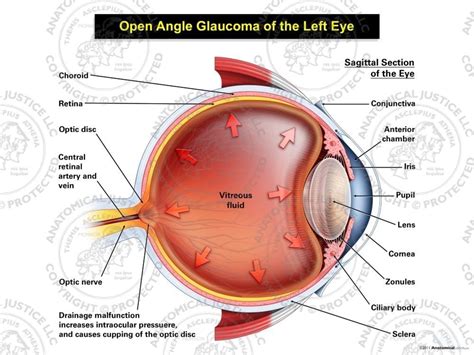 Open Angle Glaucoma Eye