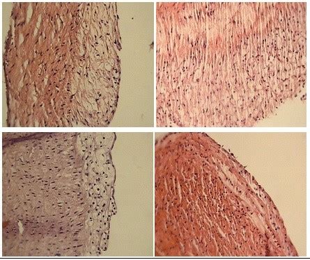 Histology of aorta and grade of atherosclerotic plaque in studied ...