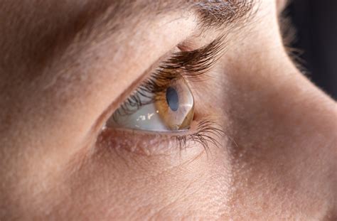 Can Keratoconus Be Cured? | Seattle & Area | Specialty Eye