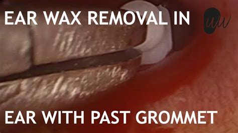 Ear Wax Removal in Ear with past Grommet - #368 - YouTube