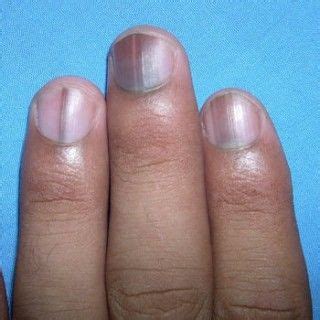 Effects Of Nutrient Deficiency On The Nails: What Do They Indicate ...