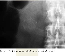 Aneurisma de arteria renal