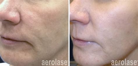 Aging Skin Before and After Gallery • Aerolase