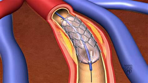 Animation - Coronary stent placement - Medical Follower