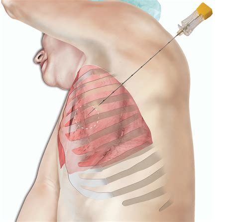 Lung biopsy | healthdirect