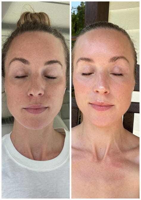 My MOXI Laser Treatment Review with Before & Afters – Natalie Yerger