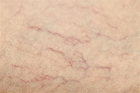 Spider Veins: Causes and Treatments