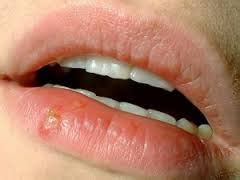 Home Remedies for Sun Blister on Your Lips | Just-Health.net