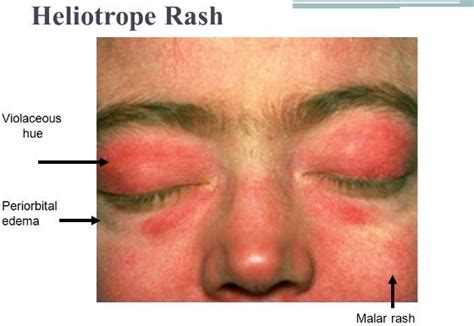 Heliotrope Rash - Images, Causes, Treatment, Symptoms, Diagnosis