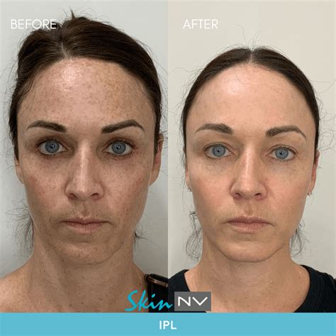 IPL Laser South Tampa Photofacial Treatment | Skin NV