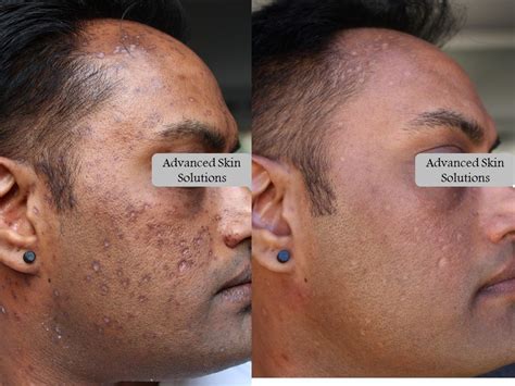 Hyperpigmentation - Advanced Skin Solutions