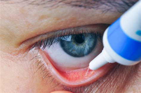 Topical Tacrolimus Enables Vernal, Atopic Keratoconjunctivitis Remission - Optometry Advisor
