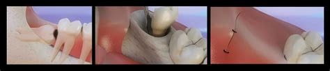 Wisdom Tooth Surgery - Summer Dental