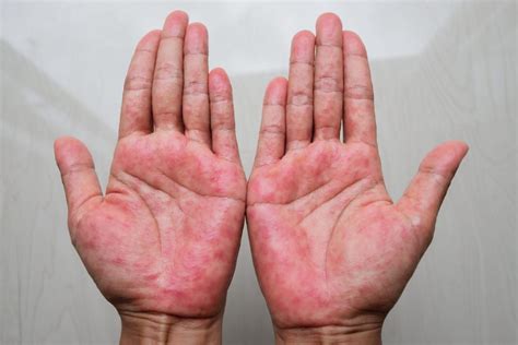 Understanding Atopic Dermatitis: Causes, Symptoms, and Treatment Options