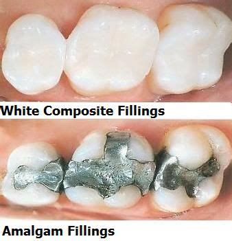 Why use composite fillings?