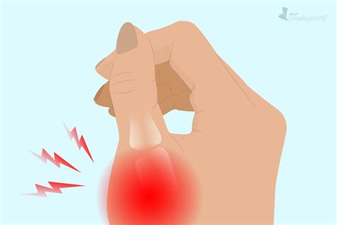 Treatment For Gout In Hands