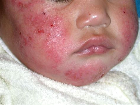 Eczema On Face Kid at Mamie Young blog