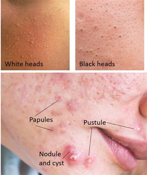 Stages of acne - basics explained by a dermatologist.