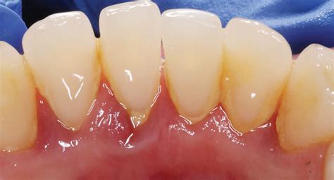 Successful Strategies for Periodontal Debridement