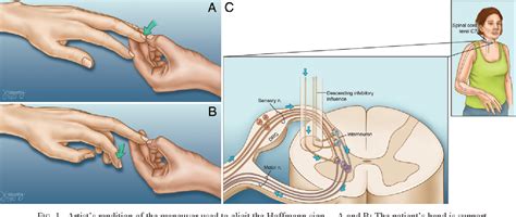 [PDF] Clinical correlations of cervical myelopathy and the Hoffmann sign. | Semantic Scholar