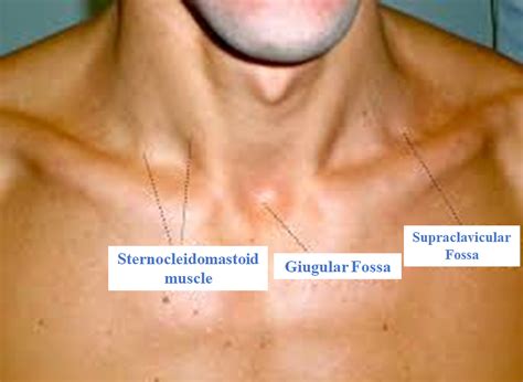 Anatomy, Shoulder and Upper Limb, Supraclavicular Fossa Article