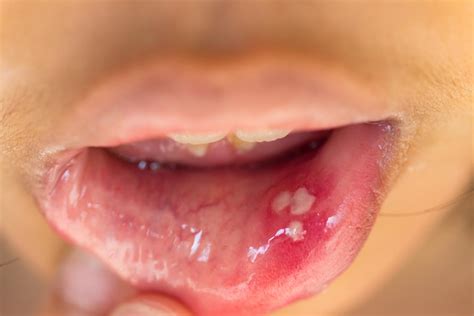 Hpv Mouth