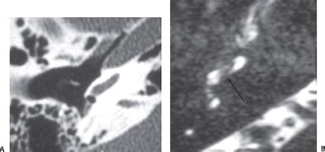 Labyrinthitis Ossifications | Radiology Key