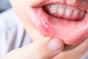 Painful Bumps in the Mouth? A Dentist Explains What They Are