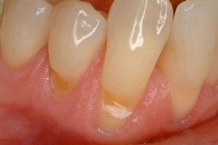 TOOTH ABRASION | The Dental Arcade – Blog